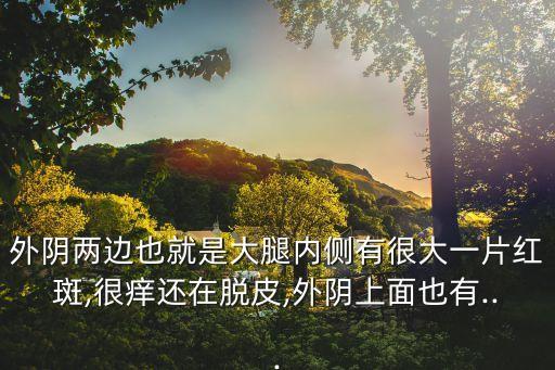 外陰兩邊也就是大腿內側有很大一片紅斑,很癢還在脫皮,外陰上面也有...